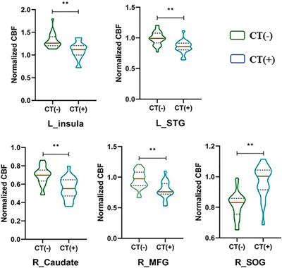 Cerebral Blood Flow and its Connectivity Deficits in Patients With Lung Cancer After Chemotherapy